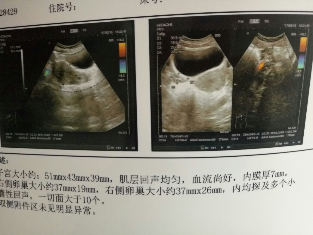 卵泡发育与取卵，卵泡长多大才适合取卵？