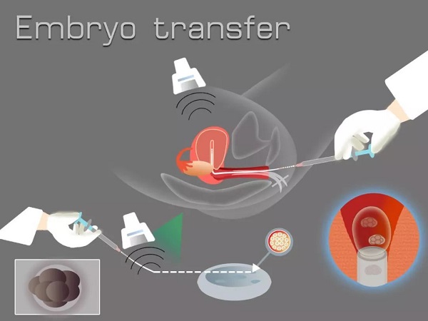 试管取卵，一种复杂的医疗过程与个体感受的交织